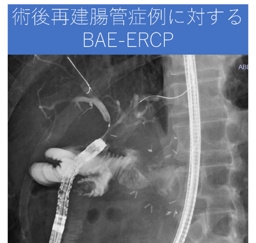 術後再建腸管症例に対するBAE-ERCP