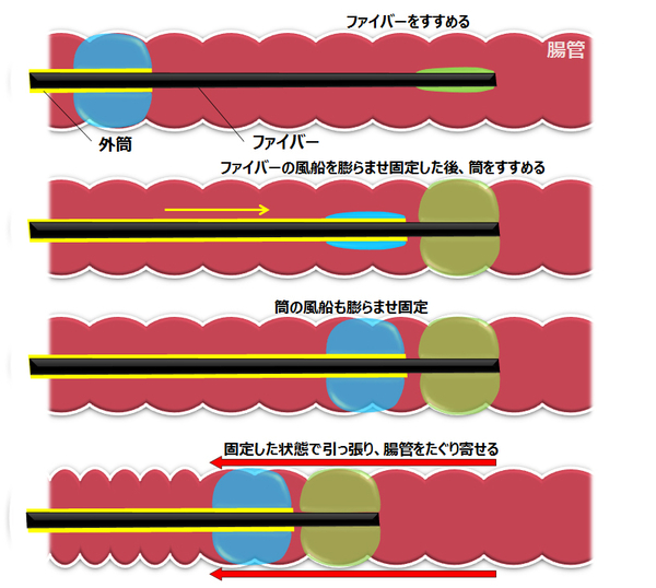 ダブルバルーン内視鏡